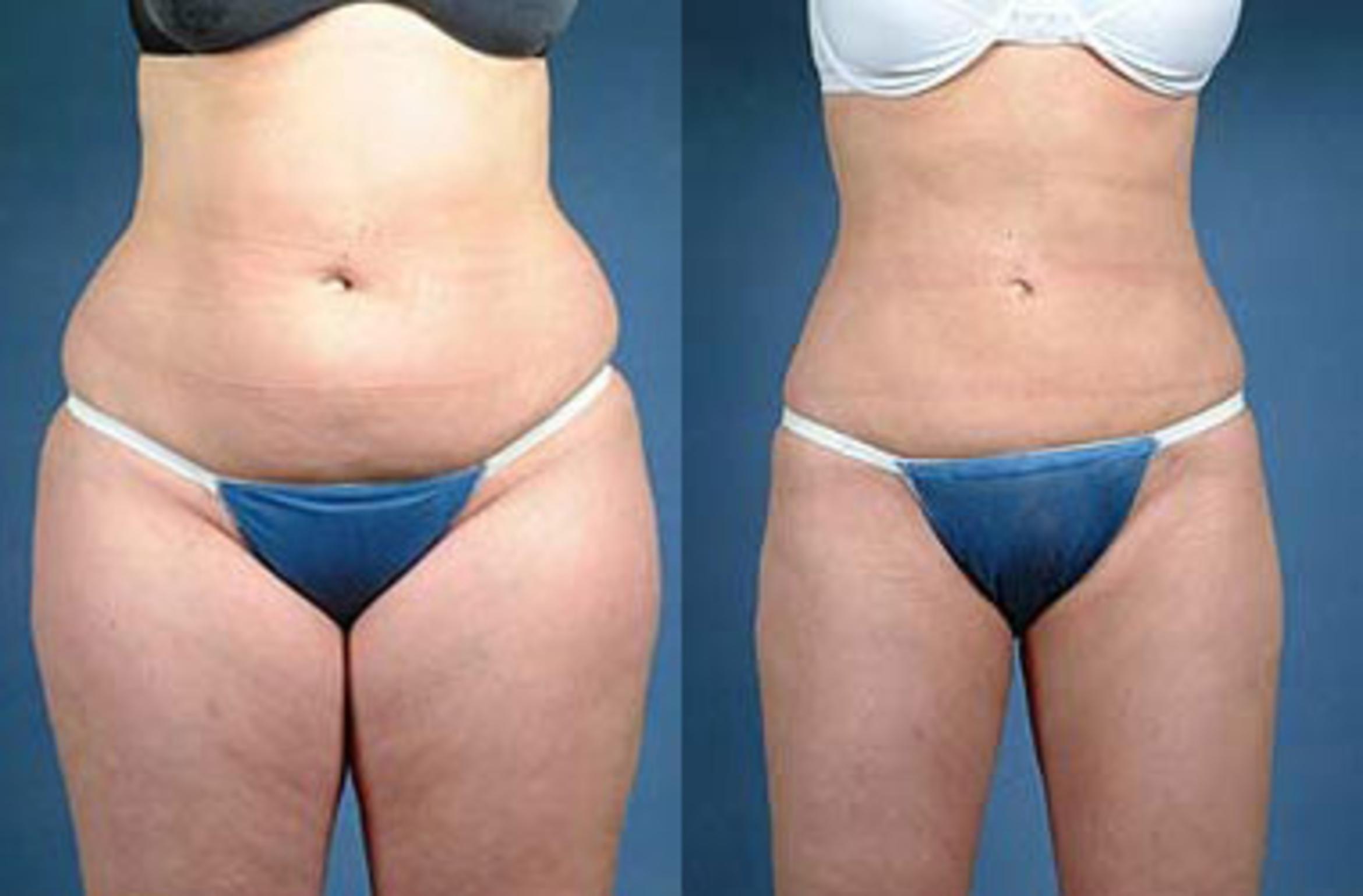 Fat reduction Lewisville