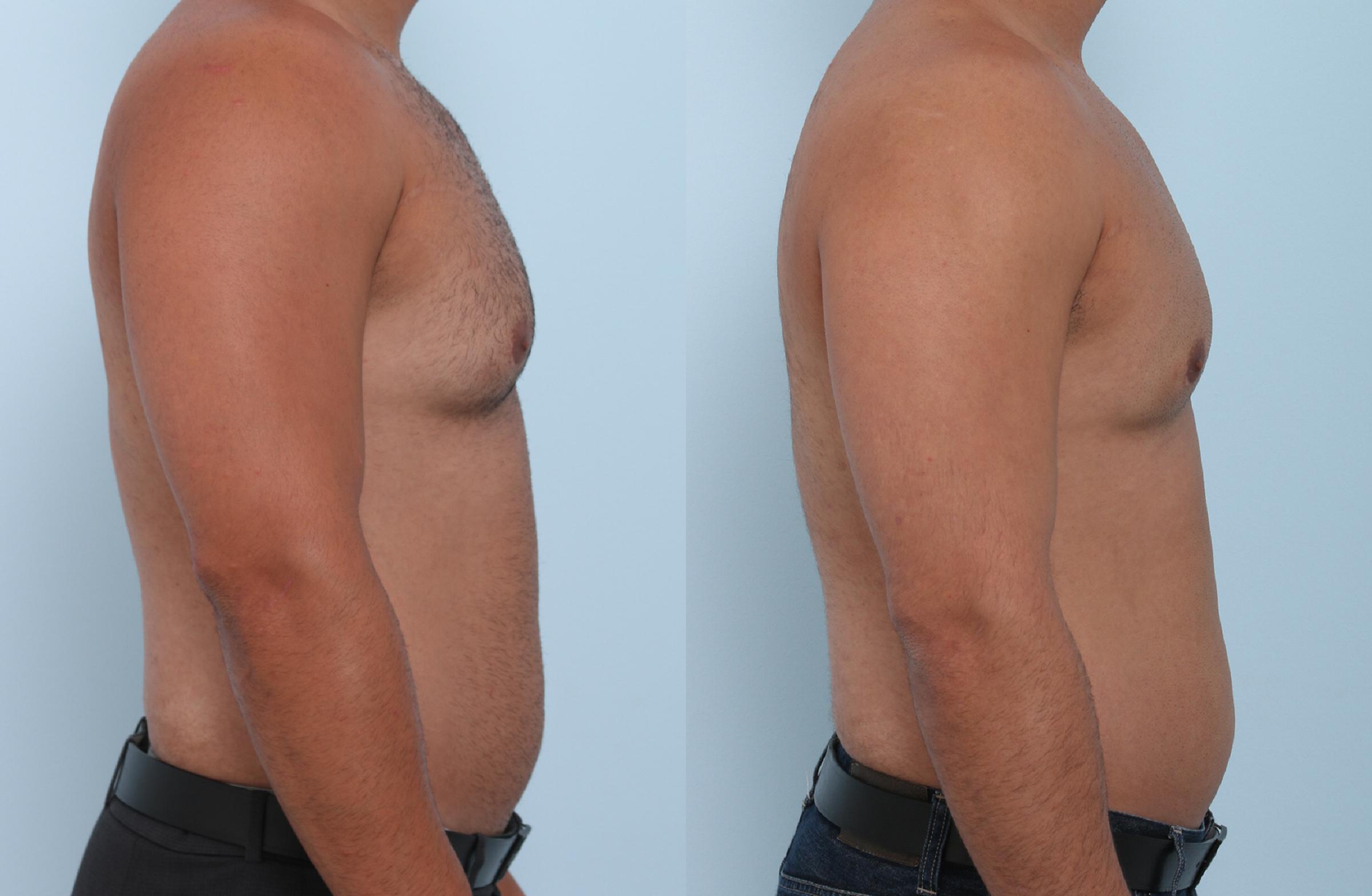 Fat removal Mansfield